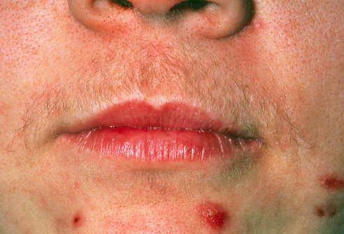 When It's More Than Acne - WebMD